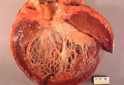 Дилатационная кардиомиопатия – таинственная мужская болезнь. 9007.jpeg
