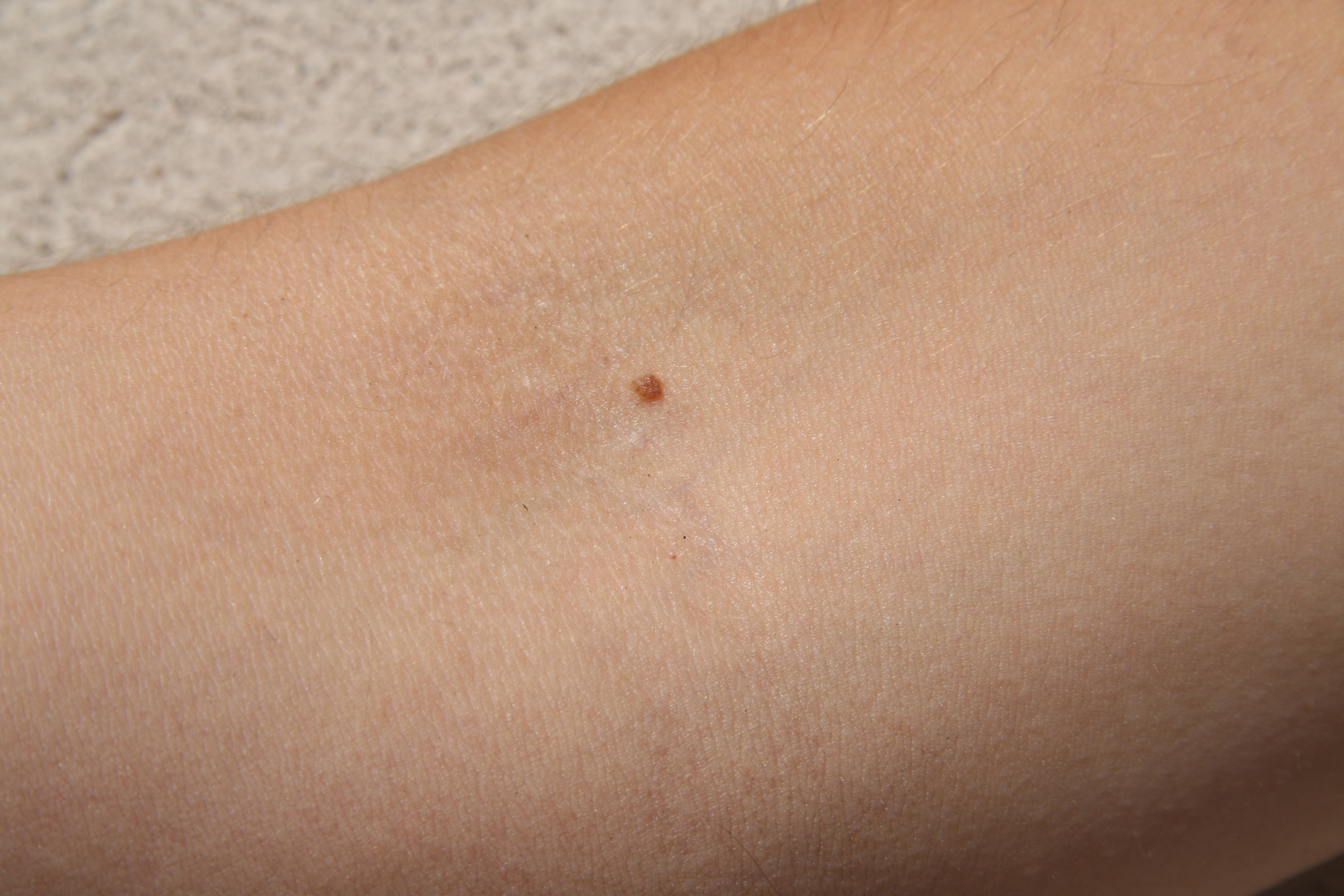 Можно повредить кожу и довести до онкологии: лазеры для удаления родинок опасны