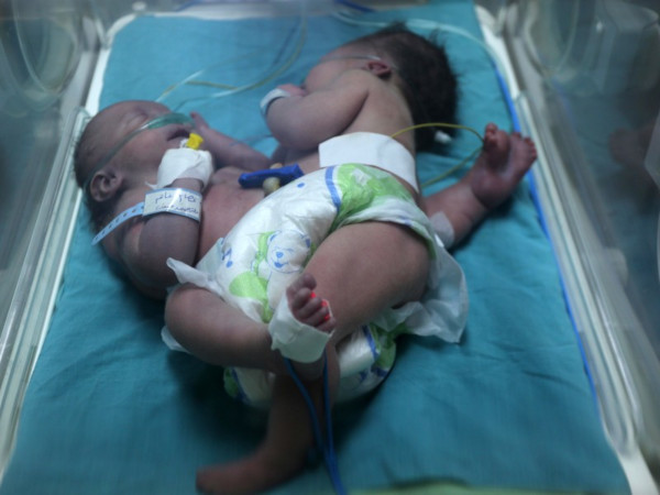 Сиамские близнецы с одним сердцем на двоих родились в Индии. медицина, здоровье, врач, сиамские близнецы, сердце, Индия