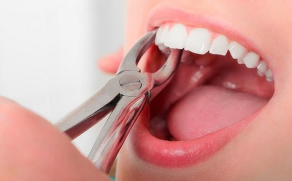 Процедура удаления зубов. 18161.jpeg