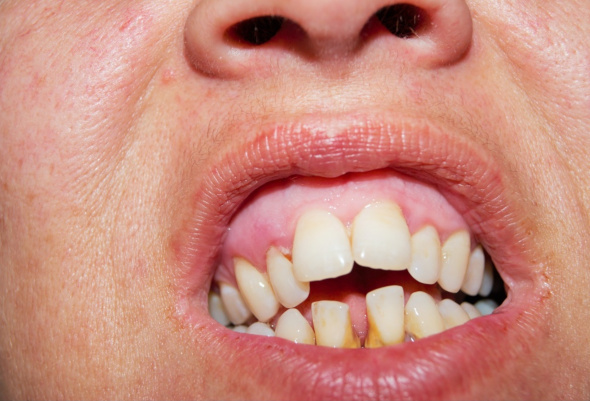 Плохое состояние зубов и десен грозит развитием слабоумия. 17201.jpeg