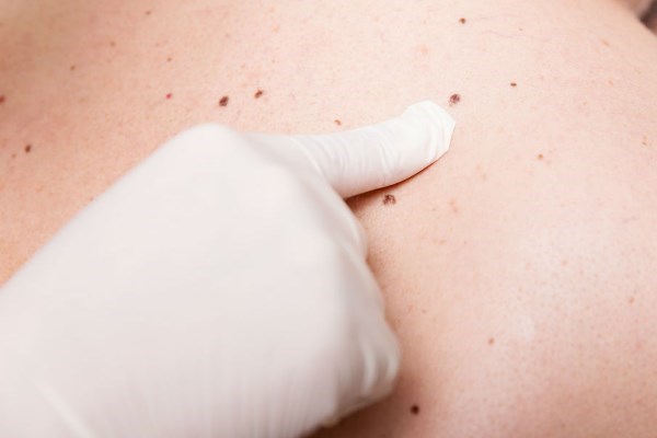 5 признаков рака кожи, которые можно выявить самостоятельно.. 16248.jpeg