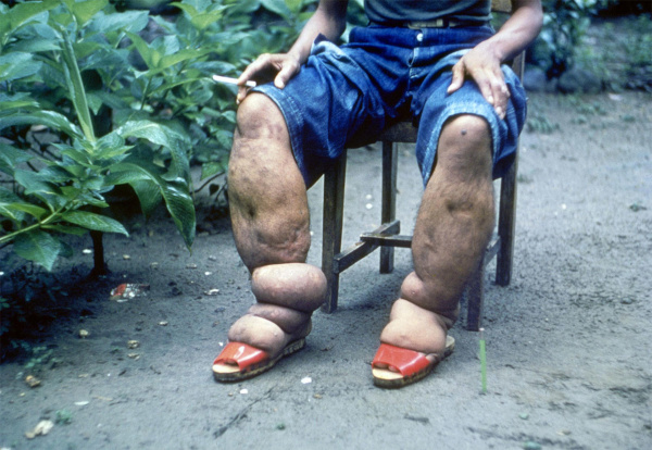 Укус комара превратил мужчину в инвалида со слоновыми ногами. 17355.jpeg