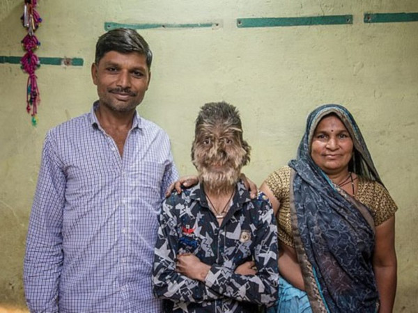 В Индии из-за редкой болезни ребенок превратился в 