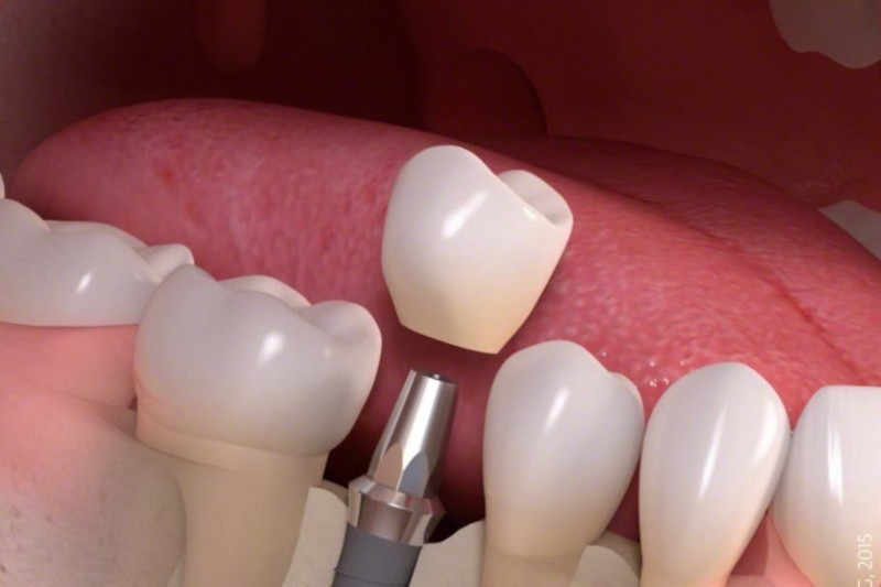 Пять мифов об имплантации зубов. медицина, здоровье, стоматология, зубы, имплантация