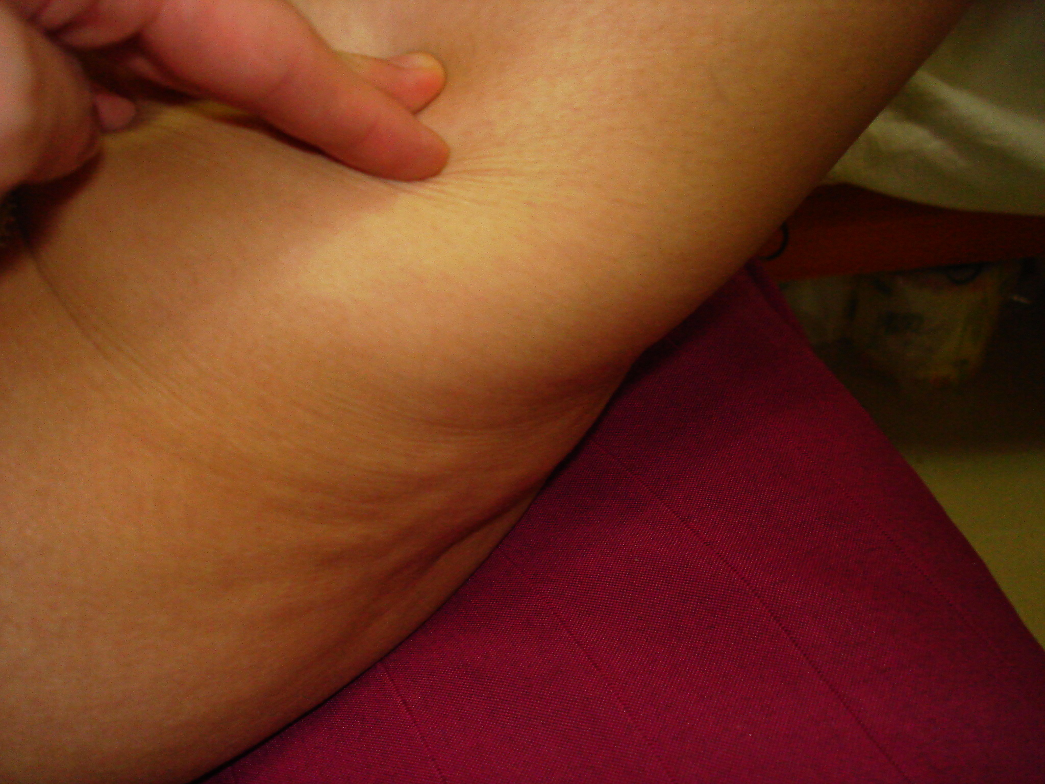 Решают спорт и генетика: полностью избавиться от целлюлита не получится