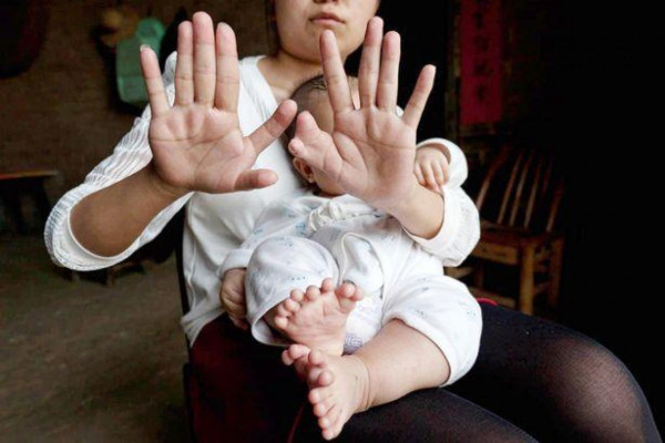 В Китае родился ребёнок с 31 пальцем. медицина, здоровье, ребенок, пальцы, Китай
