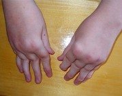 Ревматоидный артрит у детей: когда придет помощь?. 8626.jpeg