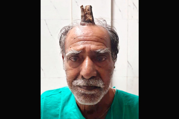 «Дьявольский рог» размером более 10 см вырос у мужчины на голове. медицина, здоровье, врач, мужчина, рог, Индия