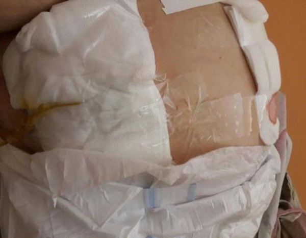В Амурской области пожилой женщине обработали операционную рану скотчем. 16733.jpeg