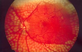 Диабетическая ретинопатия — задача на всю жизнь. 8763.jpeg