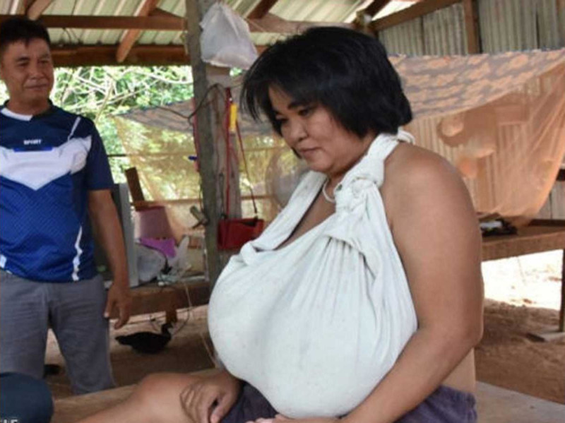 Неизвестная болезнь вызвала у жительницы Таиланда аномальный рост груди. медицина, здоровье, болезнь, грудь, Таиланд