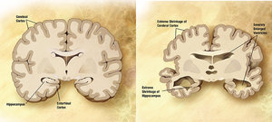 Глимфатическая система и болезнь Альцгеймера. 8822.jpeg