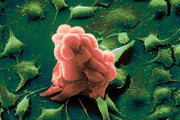 Пять способов уничтожить раковые клетки. онкология