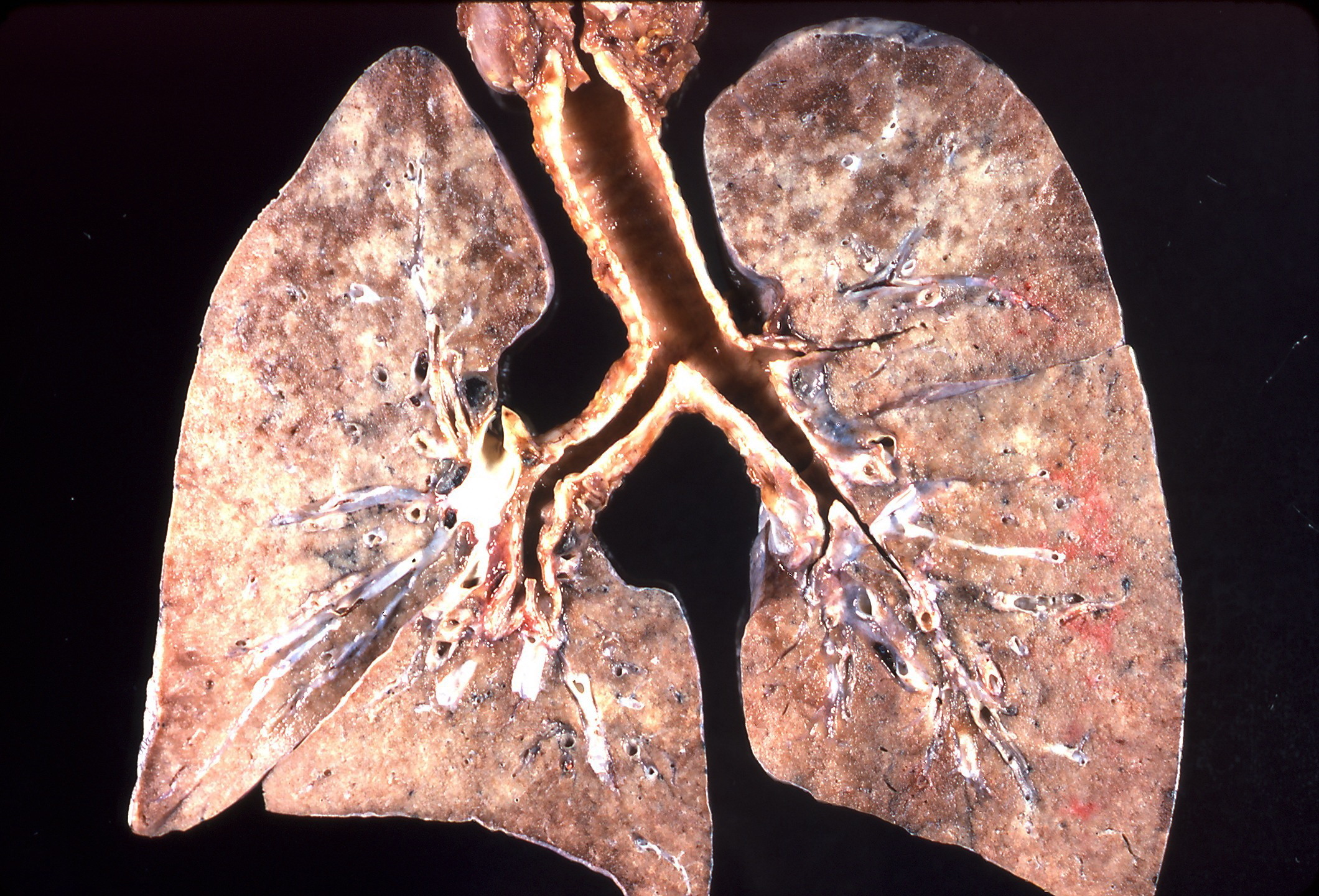 Наследственность, курение, загрязнение воздуха: это факторы риска рака легких