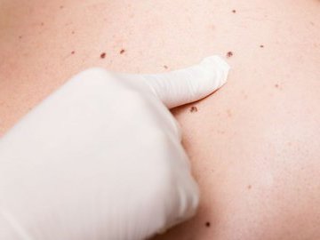 Пять признаков рака кожи, которые можно выявить самостоятельно