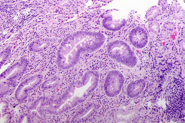 Эндокринолог Таныгина: хеликобактер может стать причиной ожирения