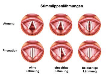 Врач Романенко: разговор до 20 часов в неделю не навредит голосу