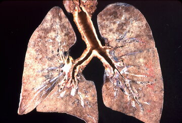 Онколог Абдуллин: вейпинг приводит к раку легких
