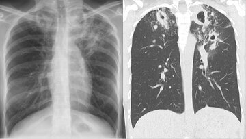 Врач Горновых: нахождение рядом с курильщиком грозит раком легких
