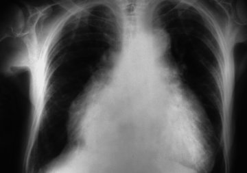 Фармацевт Говинд: одышка при простуде требует обращения к врачу