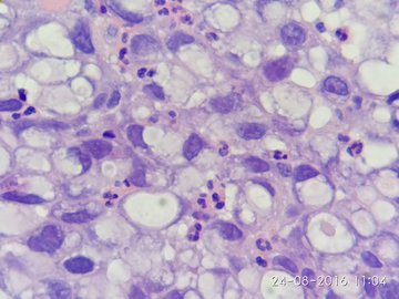 JU: риск образования камней в почках снижается после ультразвукового удаления