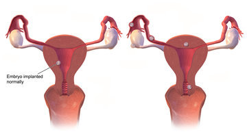 Терапевт О'Донован: миома матки вызывает боль при менструации