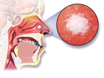 Малышева советует удалять миндалины