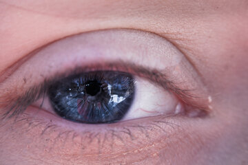 Врач Маршинцева: отложения вокруг глаз указывают на высокий холестерин