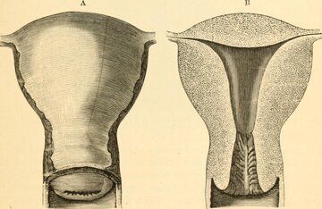 Гинеколог Ахмеров: ожирение грозит раком матки