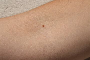 Врач Котова: лазеры с маркетплейсов для ударения родинок ведут к раку