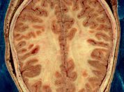 Почему болезни мозга становятся эпидемией