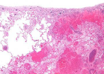 Терапевт Ашрафи: перед инсультом кожа на ногах становится блестящей