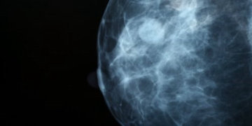 Филлоидные опухоли  молочных желез часто диагностируются у женщин 40-60 лет