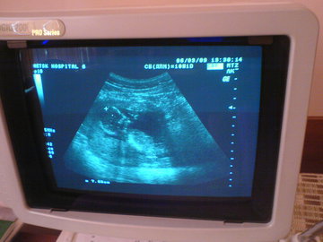 Репродуктолог Сугурова: трех УЗИ достаточно за всю беременность