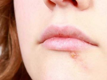 Факты о простуде на губах