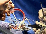Впервые в России имплантировано искусственное сердце