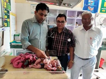 В Индии на свет появилась девочка с тремя руками и четырьмя ногами