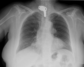 Инфекционист Венев: муколитики принимают не дольше 3-5 дней