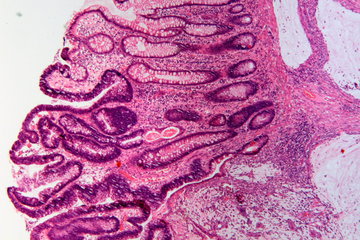 Ученые: на рак указывает твердая и неподвижная шишка на теле