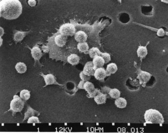 Futura Sciences: ночная потливость может указывать на рак