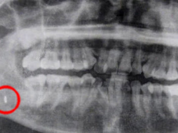 В Таиланде врачи извлекли из челюсти пациентки забытый инструмент