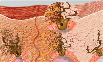 Врач Коновалов: размытый край родинки указывает на рак