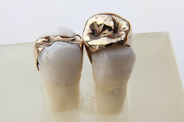 Стоматолог Антонов: хорошая пломба не может выпасть из-за жвачки