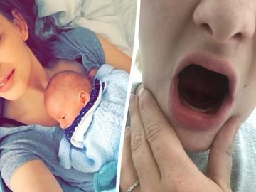 Женщине удалили все зубы из-за редкой рвоты, из-за которой они выпадали