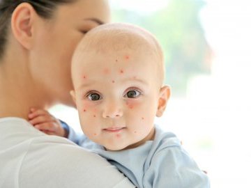 Ветрянка: симптомы и лечение