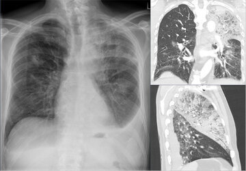 Врач Уланкина: пневмония вызывает боль в груди при вдохе