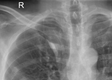 Врач Авдеев: внебольничная пневмония опасна для россиян