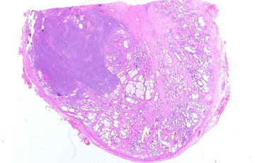 Онколог Калинин: рак простаты может протекать без симптомов