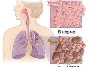 Пульмомобиль выйдет на большую дорогу